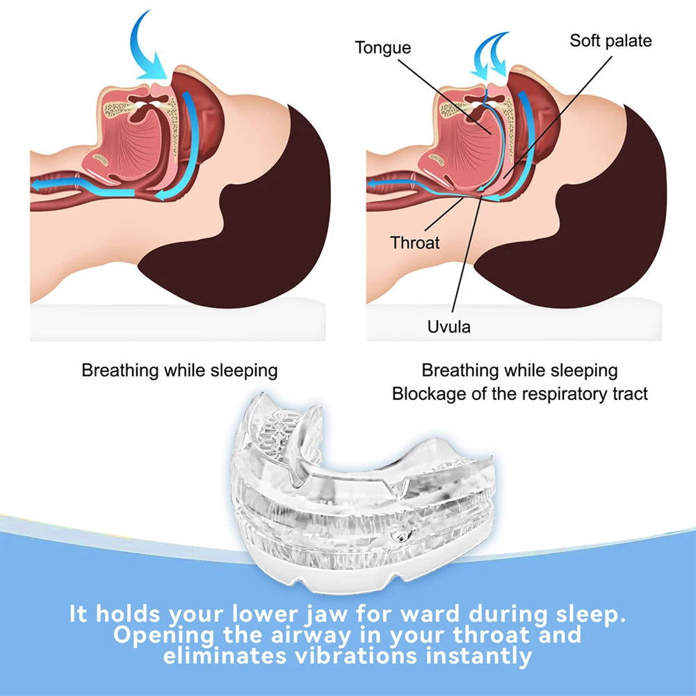 Anti Snoring Mouth Guard – Adjustable Snore Device for Sleep