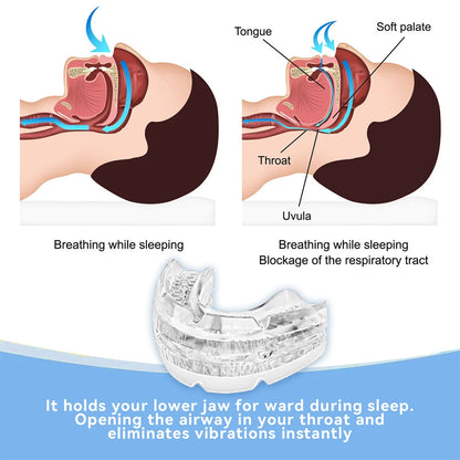 Anti Snoring Mouth Guard – Adjustable Snore Device for Sleep