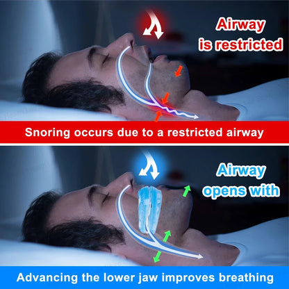 Adjustable Anti-Snoring Mouth Guard - Improve Sleep Comfortably